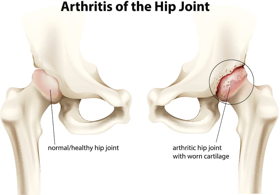Illustration showing hip joint with arthritis vs normal joint on white background