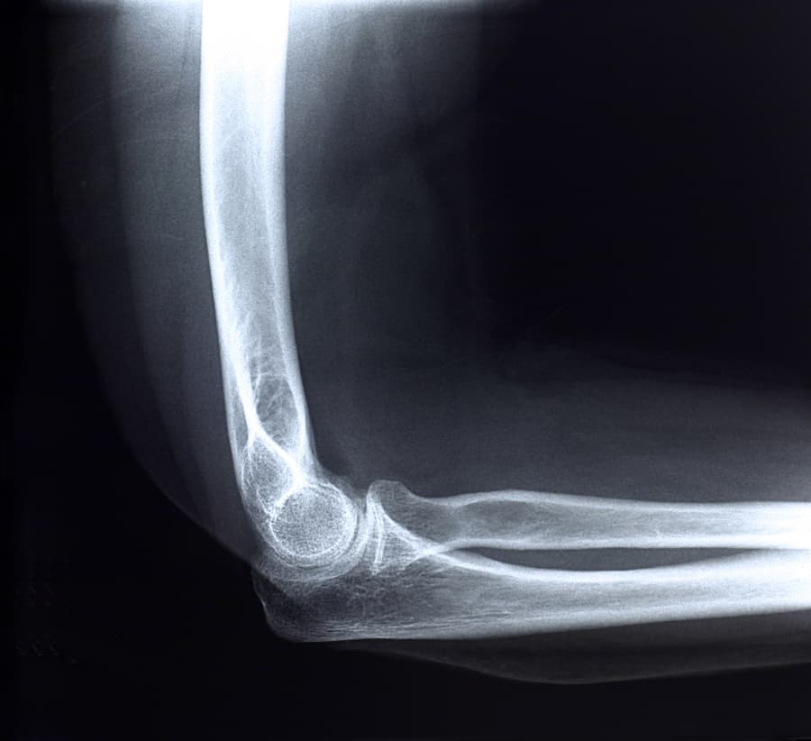 X-ray of elbow and forearm to help diagnose a UCL injury