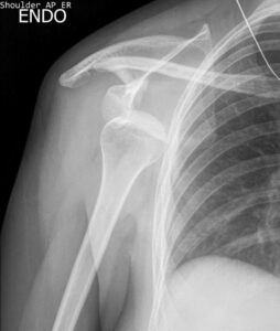 X-ray image of dislocated right shoulder