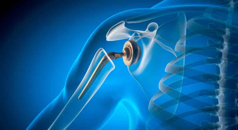medical illustration of shoulder joint replacement implant